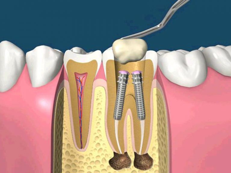 После удаления канала болит зуб. Анкерный штифт в стоматологии. Штифт для пломбирования корневого.